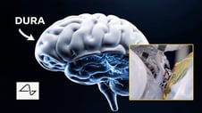 Artikelbild för artikeln: Neuralink med banbrytande framsteg